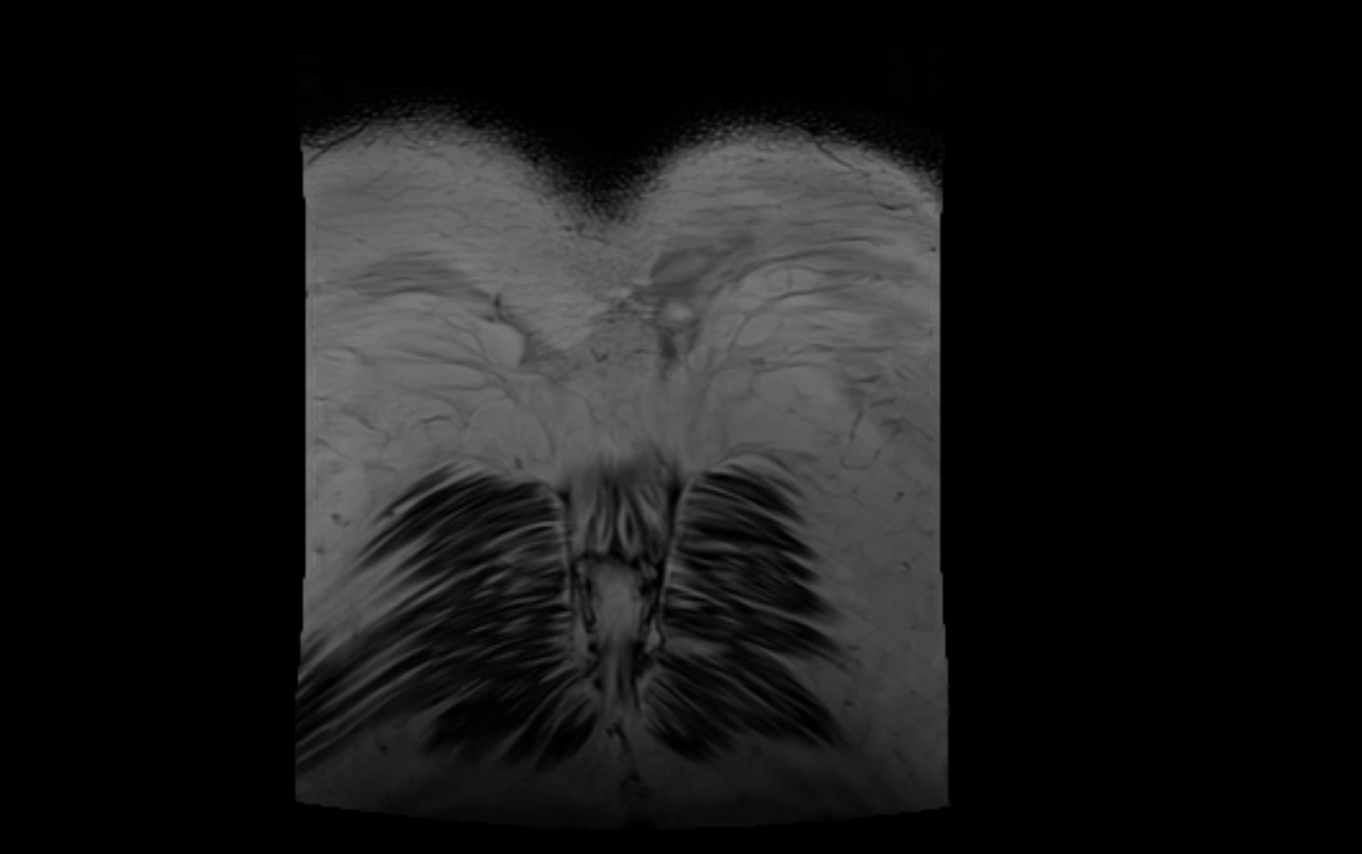 MR lumbosacral plexus cross sectional anatomy 3T  radiology  image-img-09001-00088.webp